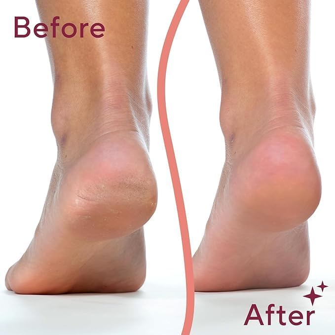 Dead Skin Remover I Callus Remover For Feet I Rechargeable Pedicure Tool