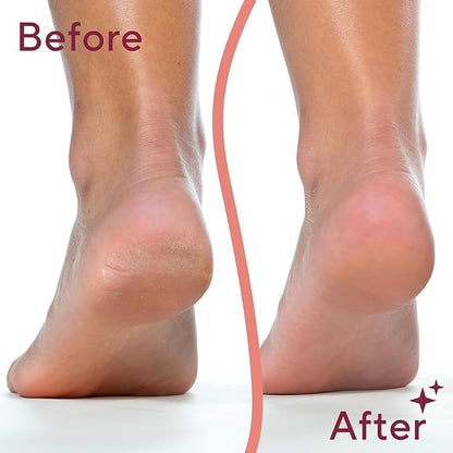 Dead Skin Remover I Callus Remover For Feet I Rechargeable Pedicure Tool